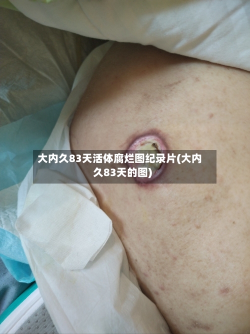 大内久83天活体腐烂图纪录片(大内久83天的图)